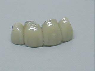 Prtesis de Porcelana